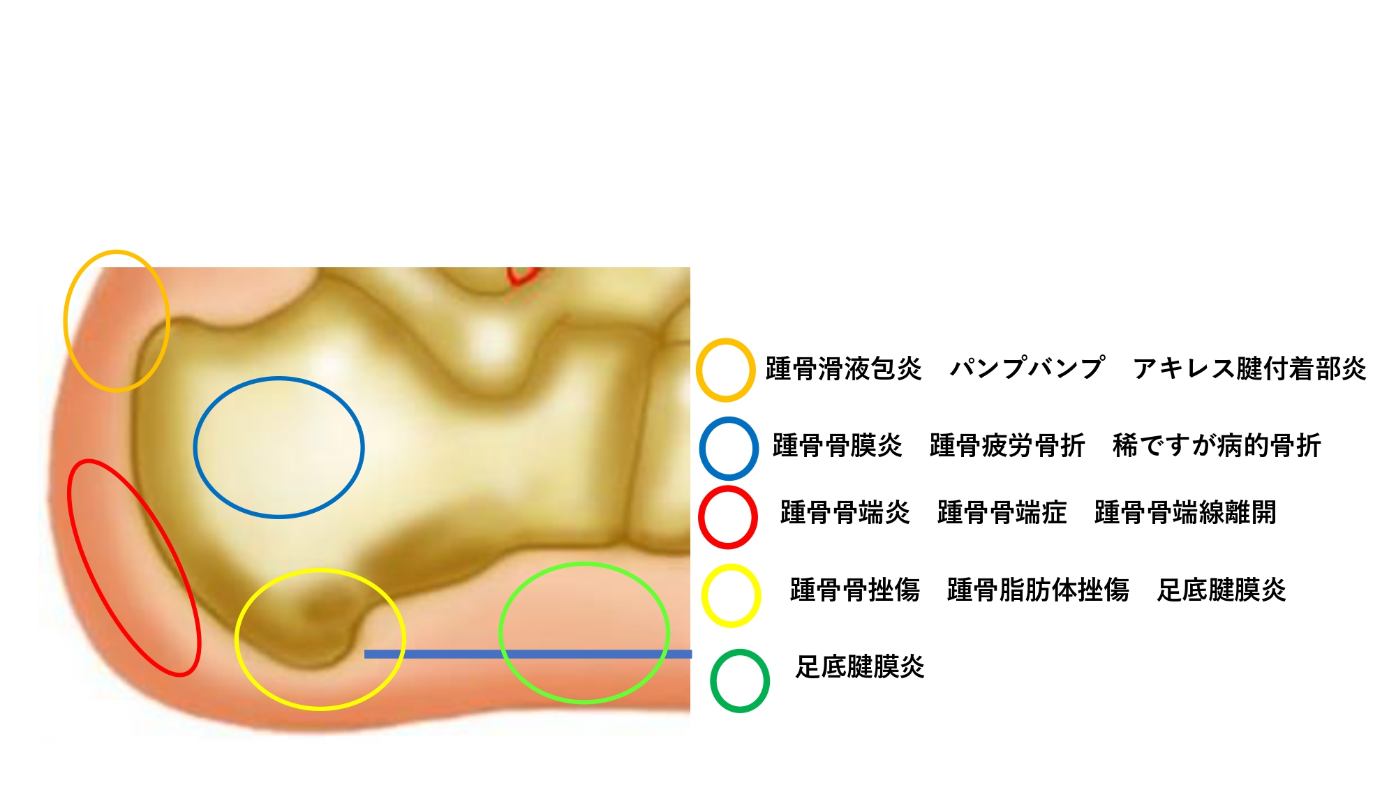 骨 挫傷 と は