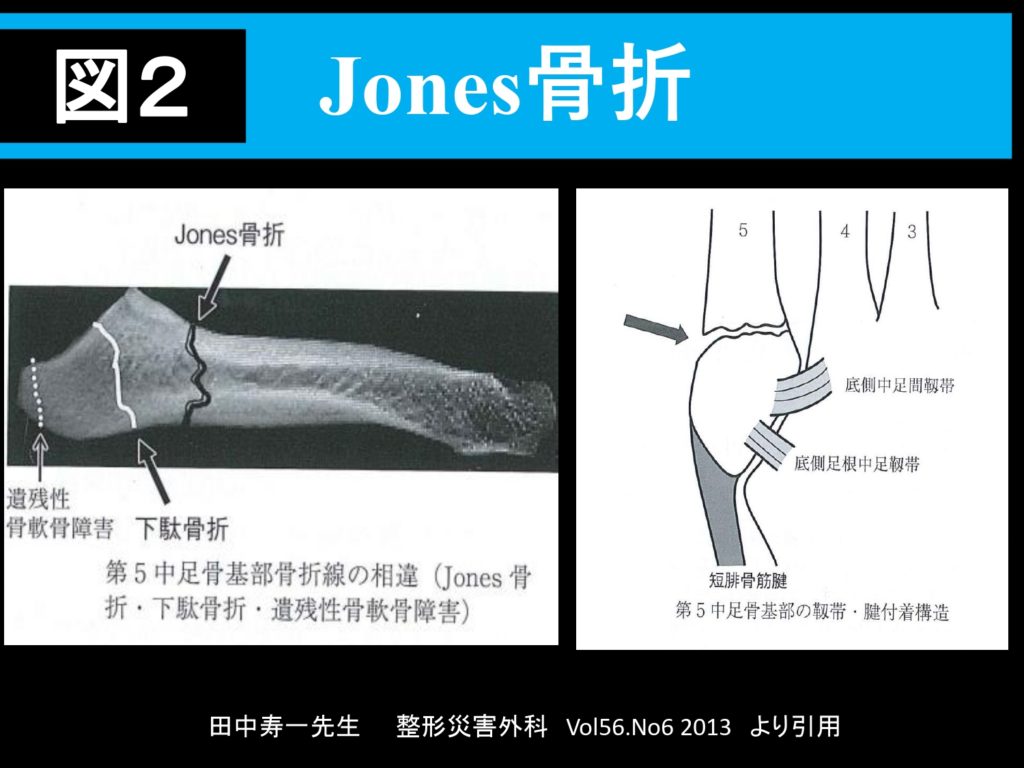 ジョーンズ骨折はご存知ですか 福岡市城南区の整形外科 タケダスポーツクリニック