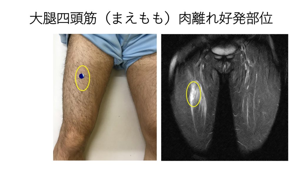肉離れ好発部位マップ 下肢 長期離脱しないために 福岡市城南区の整形外科 タケダスポーツクリニック