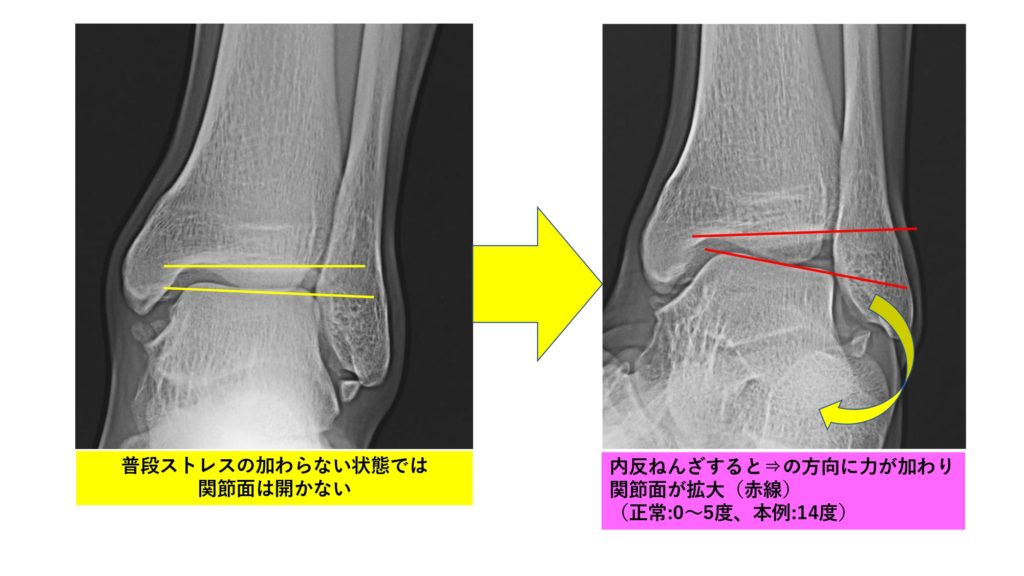 足関節外側靭帯機能不全 足首が緩い 皆さん こんなご経験はありませんか 福岡市城南区の整形外科 タケダスポーツクリニック