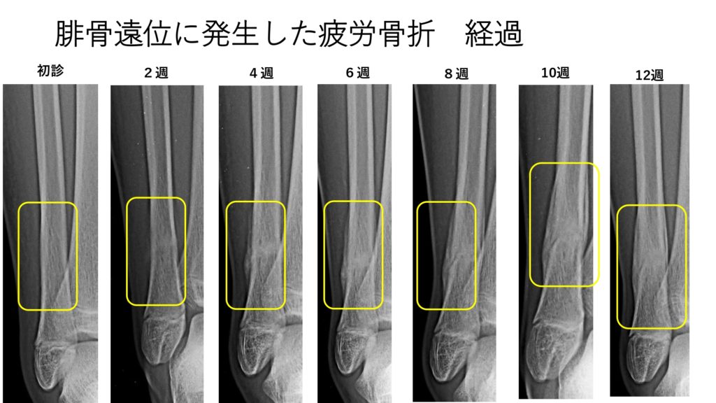 腓骨の疲労骨折 今回は腓骨という 下腿の細い方の骨の話題です 福岡市城南区の整形外科 タケダスポーツクリニック