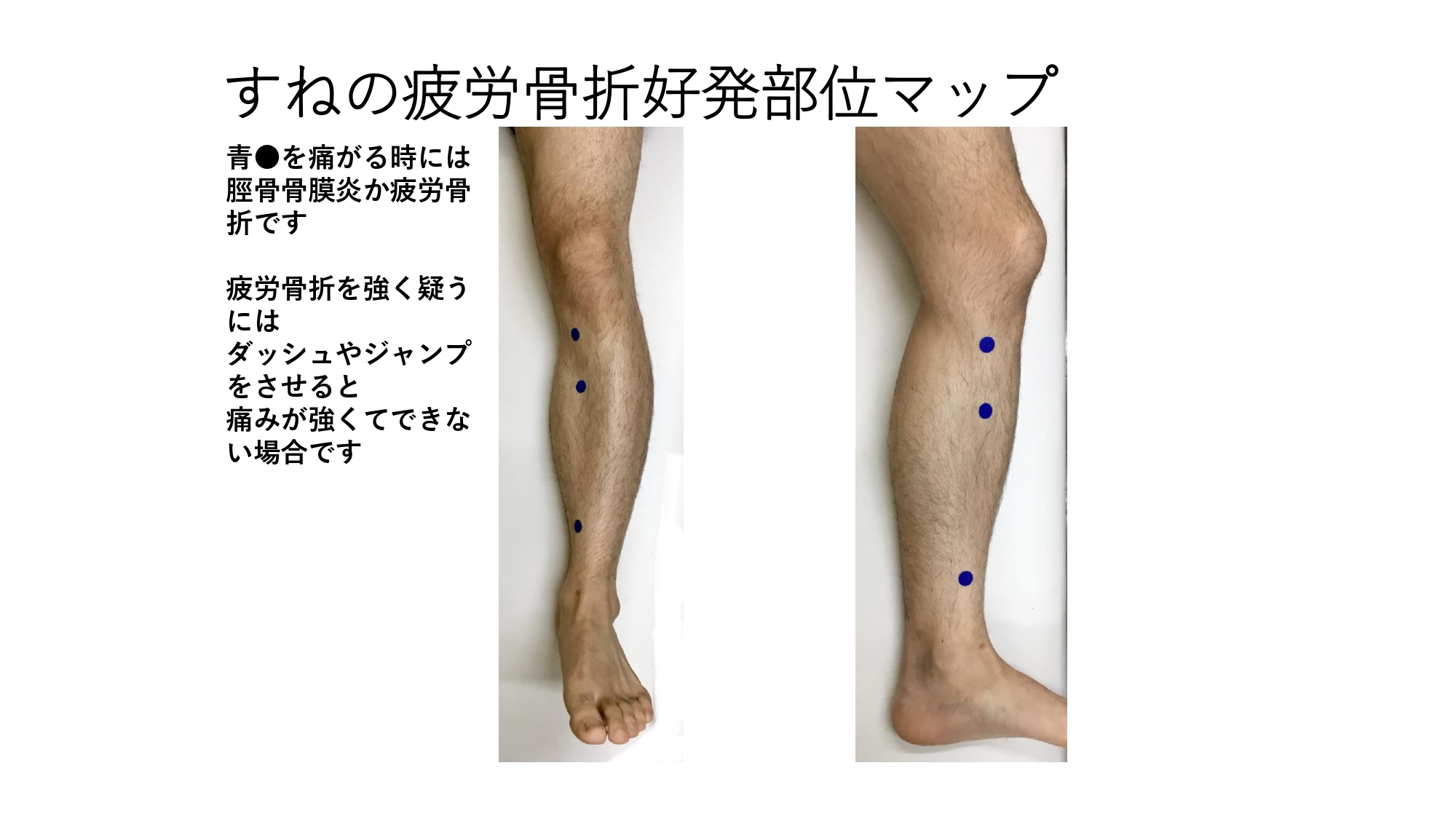 疲労骨折があることはどうやってわかりますか?