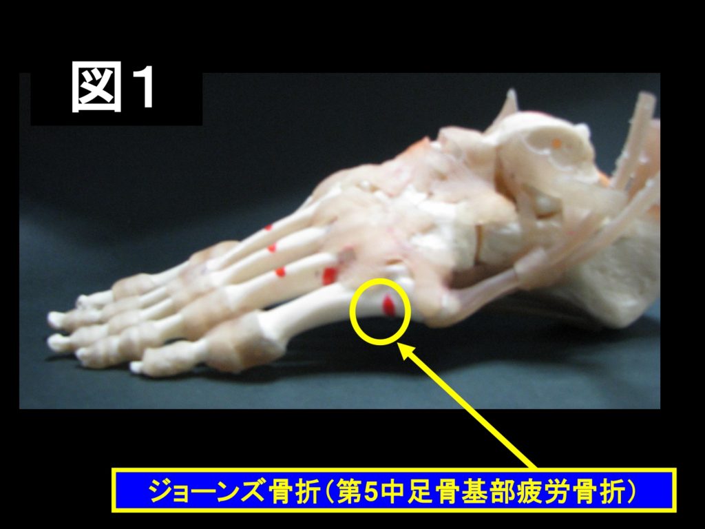 ジョーンズ骨折はご存知ですか 福岡市城南区の整形外科 タケダスポーツクリニック