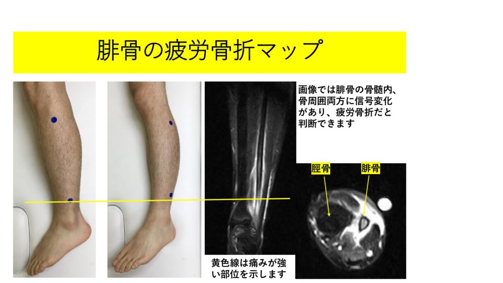 腓骨の疲労骨折 今回は腓骨という 下腿の細い方の骨の話題です 福岡市城南区の整形外科 タケダスポーツクリニック