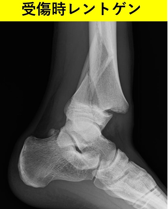 足関節骨折でギプス巻いて外したら 足の母趾の動きが悪くなり復帰できません 福岡市城南区の整形外科 タケダスポーツクリニック